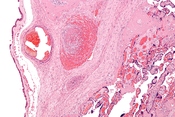 English: Low mag. Image: Fetal thrombotic vasculopathy - intermed mag.jpg