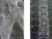 Dual-energy X-ray absorptiometry (DEXA) assessment of bone mineral density of the femoral neck (A) and the lumbar spine (B): T scores of - 4.2 and - 4.3 were found at the hip (A) and lumbar spine (B), respectively in a 53 year-old male patient affected wi