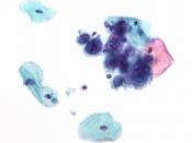 English: Micrograph showing the changes of herpes simplex virus (HSV). Pap test. Pap stain. The changes seen above may also been seen with the varicella zoster virus (VZV).