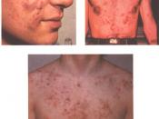 English: Acne Vulgaris: A: Cystic acne on the face, B: Subsiding tropical acne of trunc, C: Extensive acne on chest and shoulders.