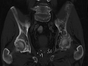 English: Paget's disease of bone in left pelvis shown in CT. Notice the seeds in the prostate after brachytherapy. Deutsch: Morbus Paget des Beckens (links, rechte Bildseite). Beachte die Seeds nach Brachytherapie der Prostata.
