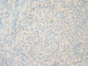 Granulosa Cell Tumor of the Ovary, CEA Immunostain