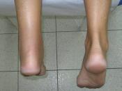 Français : Rupture du tendon d'Achille ou tendon calcanéen gauche