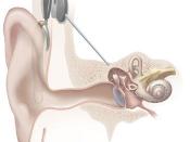 Illustration of internal parts of a cochlear implant