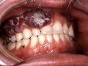 English: This HIV-positive patient presented with an intraoral Kaposi’s sarcoma lesion with an overlying candidiasis infection. This AIDS patient exhibited a CD4+ T-cell count