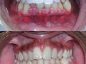 English: Really bad gingivitis, before and after scaling.