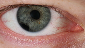 Chmee2's eye injury caused by impact of small plastic body. Part of the iris was torn off and pupil has became asymmetric due to damage to the nerves.