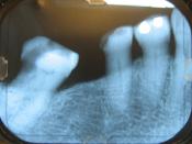 English: Dental x-ray example showing Right pre-molar