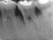 English: Evidence of furcal bone loss on #18 (lower left permanent second molar)