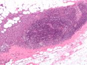 English: Micrograph showing a lymph node invaded by ductal breast carcinoma and with extranodal extension of tumour. The dark purple (center) is lymphocytes (part of a normal lymph node). Surrounding the lymphocytes and extending into the surrounding fat 