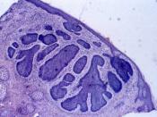 Histology of a nodular basal-cell carcinoma