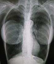 English: Chest X-ray showing bilateral breast implants.