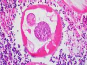 Pinworms (Enterobiasis) in the Lumen of the Vermiform Appendix