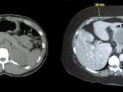 English: On the left an abdominal CT of a normal weight person. On the right the abdominal CT of an obese person.