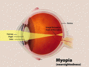 English: Diagram of Myopia in the human eye