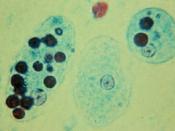 Trophozoites of Entamoeba histolytica with ingested erythrocytes (trichrome stain). The ingested erythrocytes appear as dark inclusions. Erythrophagocytosis is the only characteristic that can be used to differentiate morphologically E. histolytica from t