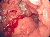 Endoscopic image of linitis plastica, where the entire stomach is invaded with gastric cancer, leading to a leather bottle like appearance. Released into public domain on permission of patient -- Samir धर्म 08:44, 7 June 2006 (UTC) Category:Endoscopic ima