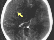 Modified version of an image originally uploaded to en.wikipedia by user:Jfdwolff with the following description: Thumbnail for version as of 19:29, March 13, 2005 322×387 (70 KB) Jfdwolff (Epidural hematoma as diagnosed in one of my patients. This image 