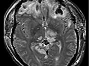 MRI of patient with brain trauma and resultant brain herniation. Caption reads, 