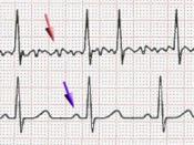 Scheme of atrial fibrillation (top) and sinus rhythm (bottom). The purple arrow indicates a P wave, which is lost in atrial fibrillation.