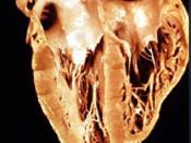 Gross anatomy of a heart that has been damaged by chronic Chagas disease - see also: Chagas heart, radiology