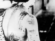 Japanese woman suffering burns from thermal radiation after the United States dropped nuclear bombs on Japan.