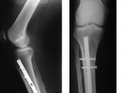 X-ray showing the proximal portion of a fractured tibia with an intramedullary nail.