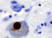English: Immunohistochemistry for alpha-synuclein showing positive staining (brown) of an intraneural Lewy-body in the Substantia nigra in Parkinson's disease.