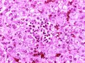 Histopathology of Reye's syndrome, liver Histopathology of autopsy liver from child who died of Reye's syndrome. Hepatocytes are pale-staining due to intracellular fat droplets.