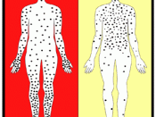 Smallpox (variola orthopox virus ) Early Rash vs chickenpox