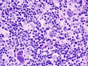 Hodgkin lymphoma (2) mixed cellulary type