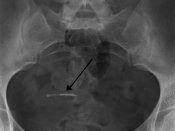 English: An IUD as seen on X ray