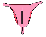 This picture shows a scheme of a frameless IUD