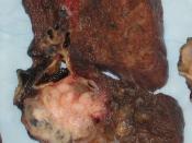 English: Gross appearance of the cut surface of a pneumonectomy specimen containing a lung cancer, here a Squamous cell carcinoma (the whitish tumor near the bronchi).