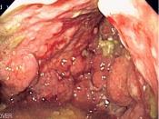 Endoscopic image of linitis plastica, where the entire stomach is invaded with gastric cancer, leading to a leather bottle like appearance. Released into public domain on permission of patient.Category:Stomachs