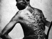 Scars of a whipped slave (April 2, 1863, Baton Rouge, Louisiana, USA. Original caption: 