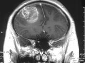English: Gliobastoma (astrocytoma) WHO grade IV - MRI coronal view, post contrast. 15 year old boy. Deutsch: Glioblastom (Astrozytom) WHO Grad IV - MRT coronale Schnittführung, nach Kontrastmittel. 15 Jahre alter Junge.