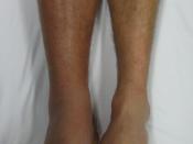 English: A deep vein thrombosis of the right leg. Note the swelling and redness.