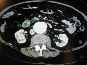 English: A contrast enhanced CT scan demonstrating an abdominal aortic aneurysm of 4.8 * 3.8 cm