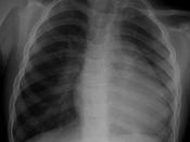English: A CXR of a child with tetralogy of fallot