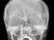 Deutsch: Tiefe Hirnstimulation bei Morbus Parkinson: Sondenverlauf in Projektion auf den Schädel auf einer Röntgenaufnahme.