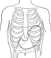 Figure 1 (according to Boas); NORMAL THORAXES AND STOMACH; - - - - - - lower Edge of the liver _________ Diaphragm. G Large intestine