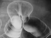 X-rays image: Double Contrast Barium Enema showing transdiafragmatic, colonic herniation