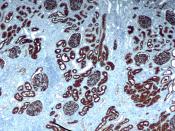 English: Immunohistochemical staining of a non-neoplastic kidney with CD10 (Nephrilysin). CD10 stains both the glomeruli and proximal convoluted tubule. CD10 is often used in a panel of immunohistochemical stains, when there is suspicion of renal cell car