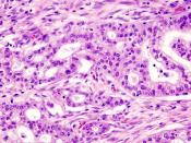 Micrograph of pancreatic ductal adenocarcinoma (the most common type of pancreatic cancer). H&E stain.