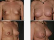 English: Plastic surgery; fat-graft breast augmentation; 4 plates (neclace)
