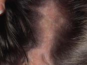 Frontal linear scleroderma with associated cicatricial alopecia on the left parietal region of the scalp.