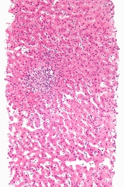 English: Low magnification micrograph of an adverse drug reaction leading to a hepatitis, also known as drug-induced hepatitis, with non-caseating granulomata. Liver biopsy. H&E stain. See also Image:Drug-induced hepatitis intermed mag.jpg Image:Drug-indu
