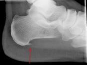English: X-ray of the heelbone with plantar fasciitis. Nederlands: Röntgenfoto van de calcaneus met plantaire fasciitis.