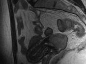English: Cervical cancer - T2 weighted saggital MR image of the pelvis Slovenčina: Karcinóm krčka maternice - T2-vážený sagitálny rez maternicou, vyšetrenie magnetickou rezonanciou